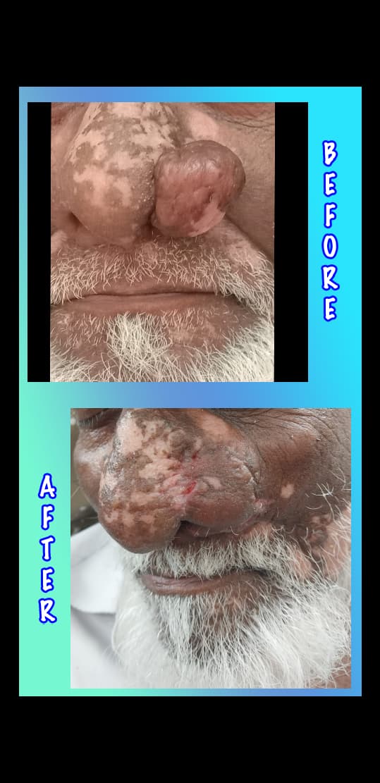 Nose tumor successfully removed and restored