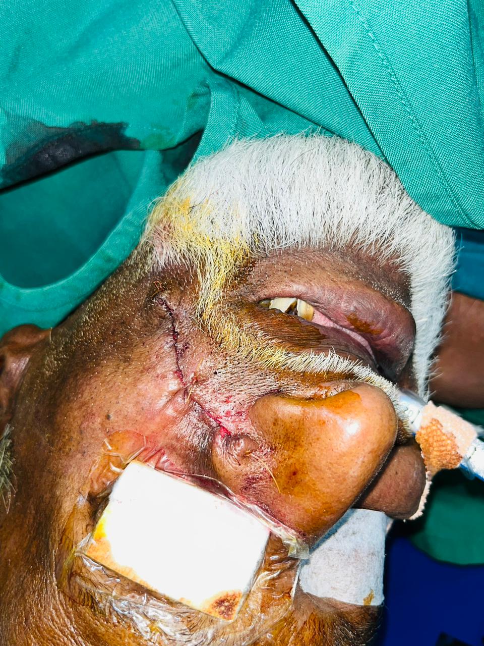 Nose after local flap reconstruction